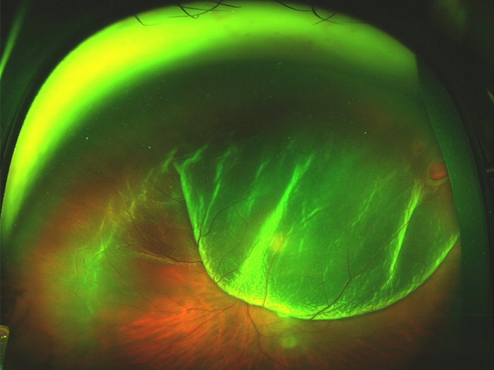 硝子体手術による回復